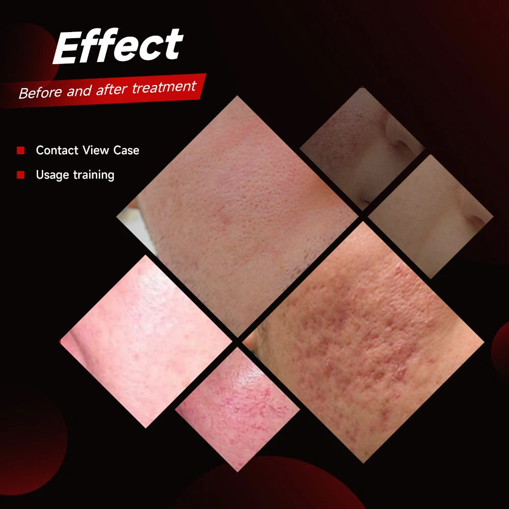 Medical CE Approved Fotona 4D CO₂ Laser | Skin Rejuvenation, Vaginal Tightening & Vascular Removal