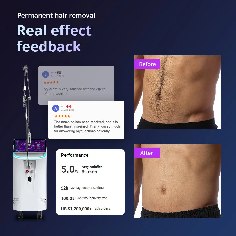 BMLASER 2025 Alexandrite 755nm GentleMax Laser Hair Removal Machine – Permanent, Pain-Free Professional Beauty Equipment