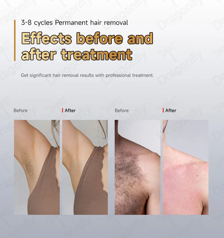 BMLASER Professional Ice-Cooled 4-Wavelength Diode Laser Hair Removal Machine – 755nm, 808nm, 940nm, 1064nm, Painless Treatment