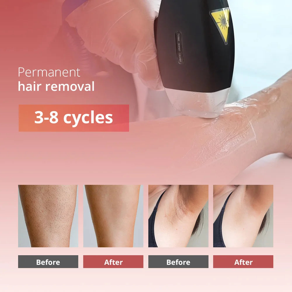 Professional Alexandrite Laser Hair Removal Machine – 5 Wavelengths, CE TUV ISO Certified, 600–2000W