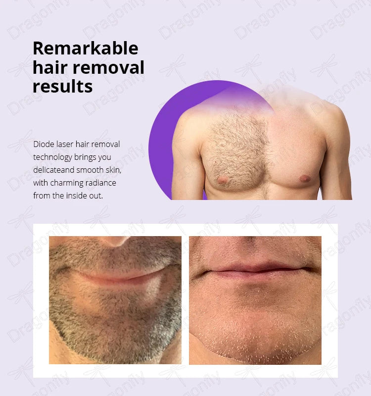 2025 AI Smart Ice Titanium Diode Laser Hair Removal Machine – Switchable Spot, Triple Wavelength