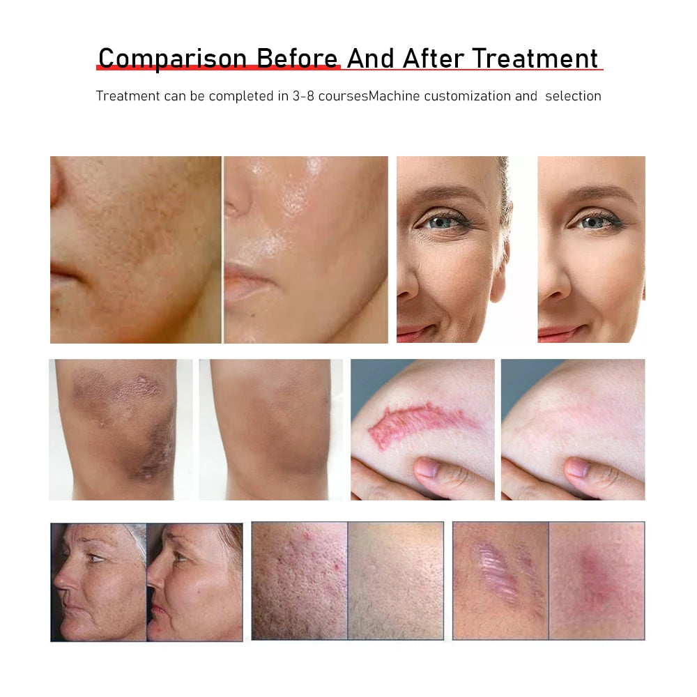 Co2 Fractional Laser Machine Portable Co2 Fractional Laser Device Beauty Salon Equipment Furniture Women  Hair Salon Equipment
