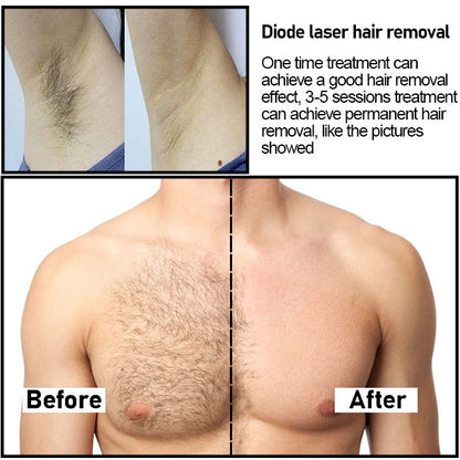 2025 New 808nm Fiber-Coupled Diode Laser Hair Removal Machine – Portable Remote-Control System for Professional Salon Use