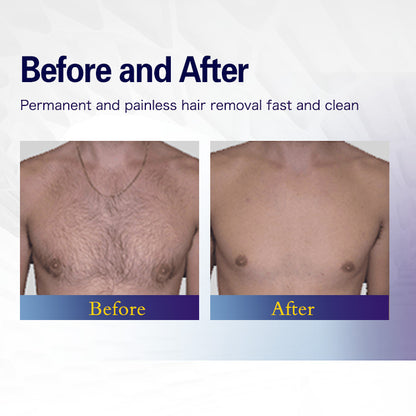 2025  Newest 808nm Diode Laser Hair Removal Machine | CE Medical Certified Beauty Equipment