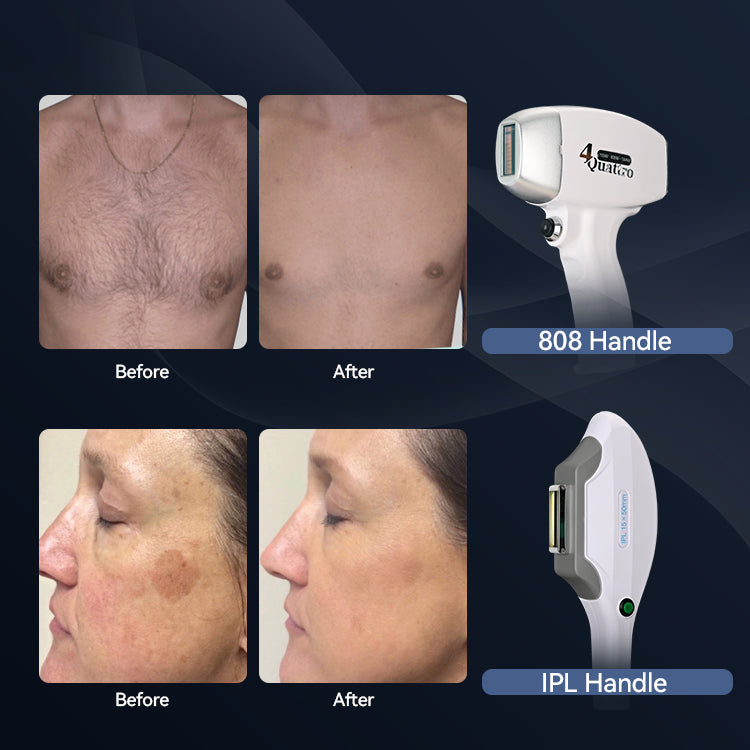 DF-Laser 2-in-1 Ice IPL Hair Removal Machine – Multifunctional, High Power 1600W/1800W/2000W, Factory Direct Price